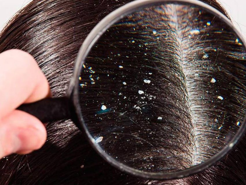 Why we should get rid of the Scalp Dandruff